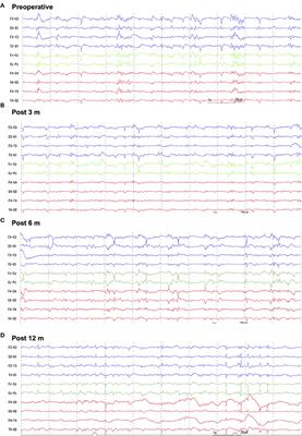 Case Report: Corpus Callosotomy in a Cat With Drug-Resistant Epilepsy of Unknown Cause